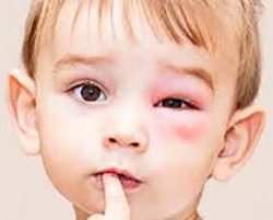Saiba identificar sinais de reações alérgicas